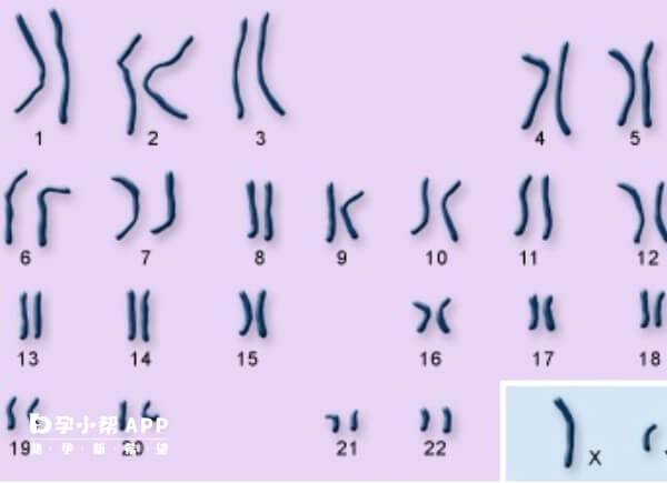 21号染色体异常会导致一些疾病