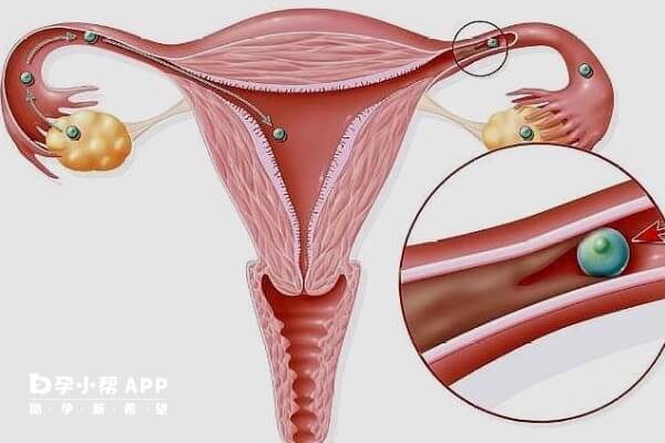 输卵管堵塞会影响怀孕