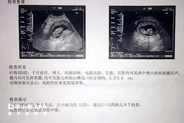 根据两个孕囊大小判断是否为龙凤胎