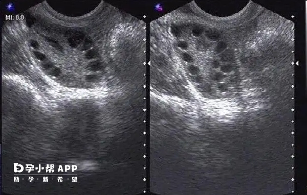 打完降调针后卵泡变少了别担心