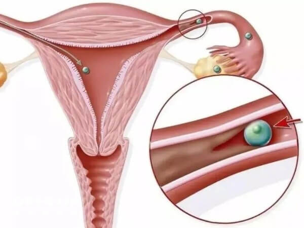 单侧输卵管受孕几率在50%左右