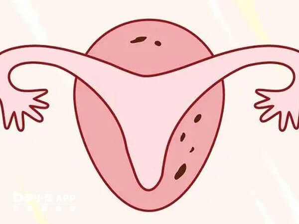 输卵管疾病会导致不孕