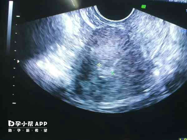 内膜转为C型了移植囊胚成功率