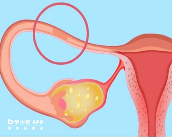 输卵管伞端堵塞一般是由输卵管炎症导致的