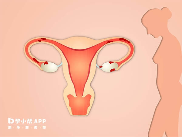 没有输卵管的女性无法正常怀孕
