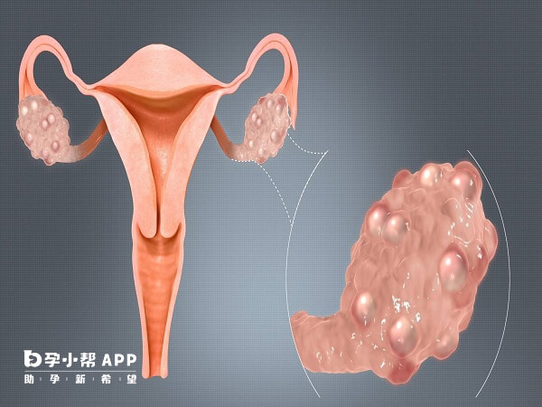 输卵管结扎手术不能预防卵巢癌