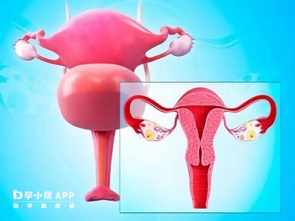 腹膜型子宫内膜异位症可以做试管
