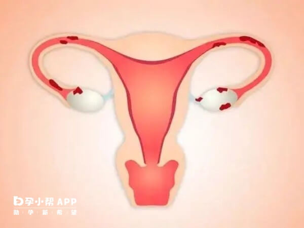 宫腔粘连4mm会影响移植后胚胎着床