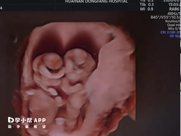 移植两个冻胚怀双胎几率为35%