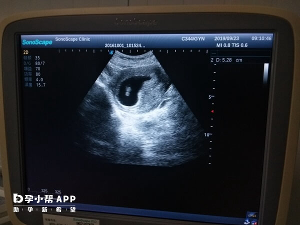 移植21天能看到孕囊