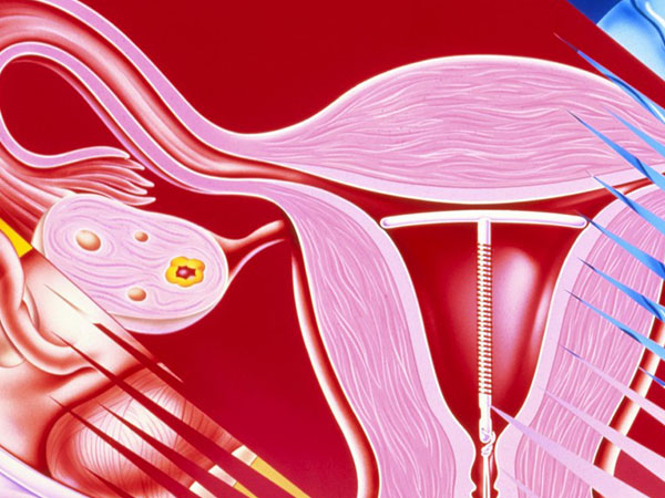 子宫腺肌症助孕除了子宫内膜活检，B超、血常规也得做