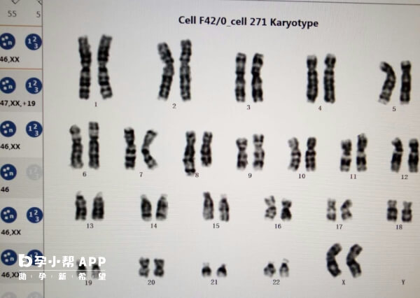 21号染色体缺失是异常的一种