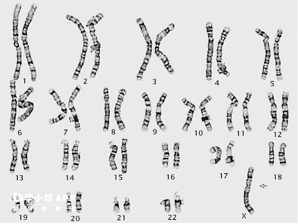 21号染色体随体柄增会影响生育
