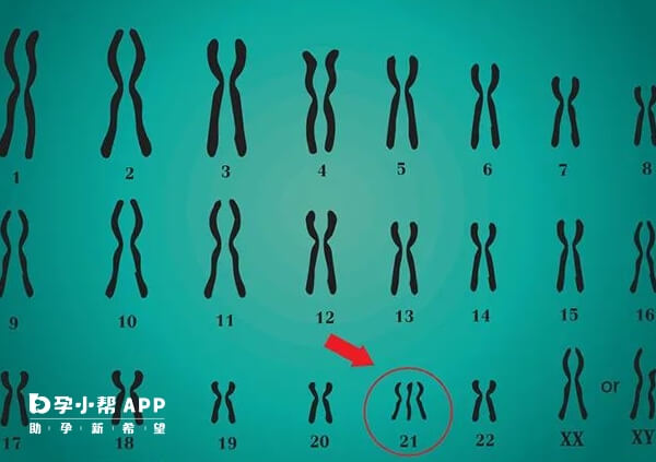 男性21号染色体异常可以要孩子
