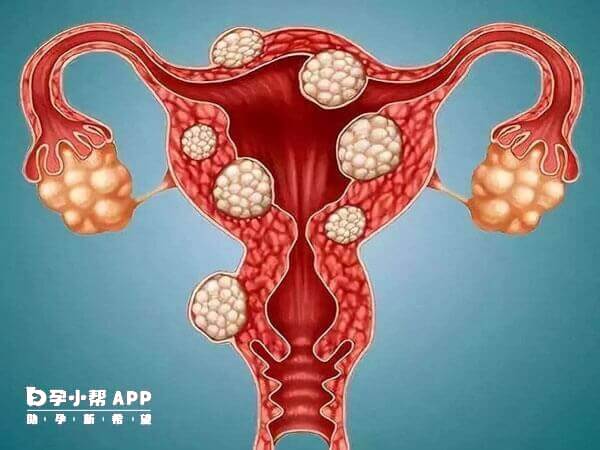 子宫肌瘤会导致月经异常