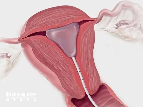宫腔粘连可通过物质理疗
