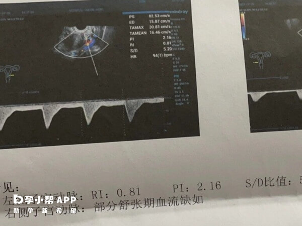 试管怀孕后子宫动脉助力多少算正常