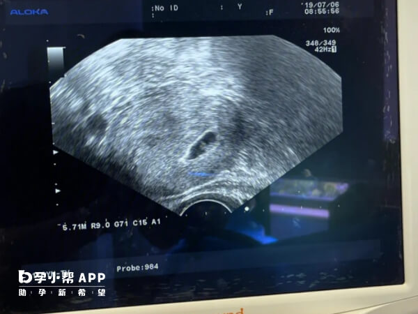 胎心胎芽检查