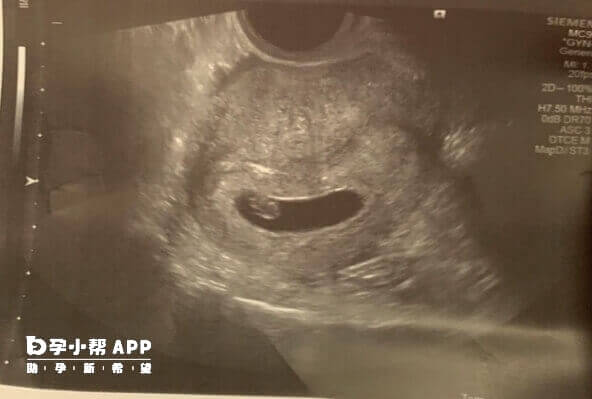 移植后第20天胚胎的发育状态
