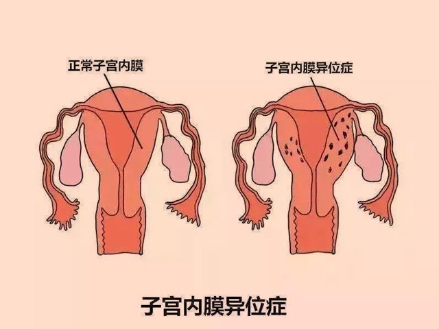 子宫内膜异位症怀孕
